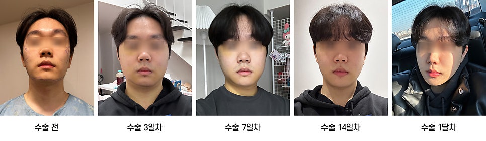 안면윤곽 수술 후 붓기, 일상생활은 언제부터 가능한가요? 케이스별로 알아보기 관련 이미지 12
