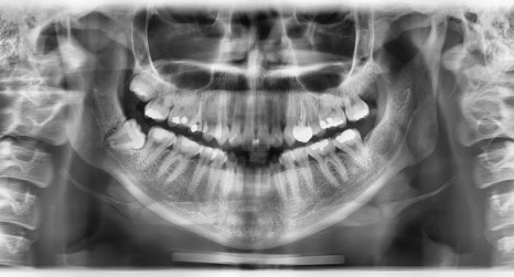 Is There a Way to Address the Secondary Angle That Appears After Chin Surgery? image 6