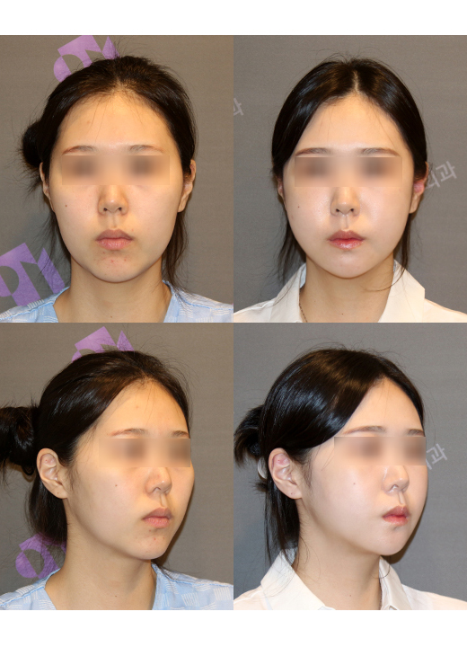 여름철 안면윤곽수술 계절의 영향을 받을까요? 관련 이미지 2