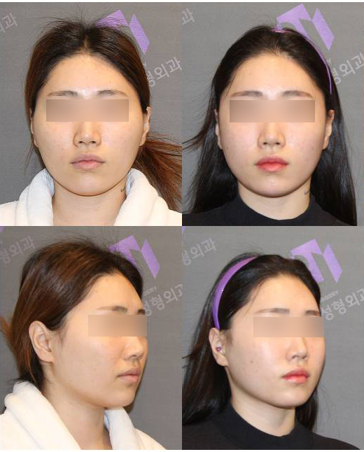 광대수술 볼처짐의 원인이라는 박리범위 제대로 파헤쳐봅니다. 관련 이미지 5