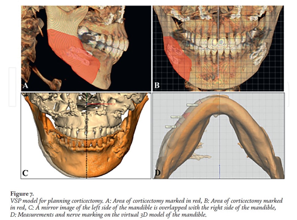 [Paper Review] Technological Advances and Real-World Applications in Modern Facial Contouring Surgery: Correction of Facial Asymmetry image 8