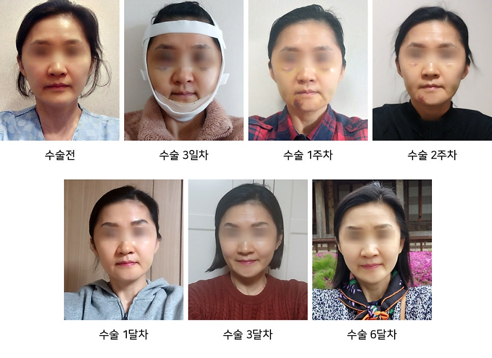 Is facial contouring surgery possible even at an older age? Important things you should know image 11