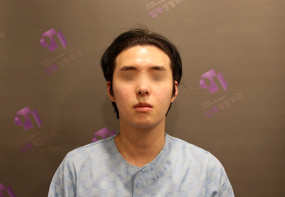 230도입체광대축소술로 재수술이 가능한 경우가 있을까요? 관련 이미지 1