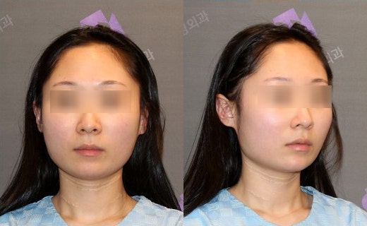 Will Jawline Surgery Make the Face’s Jawline More Defined? image 5