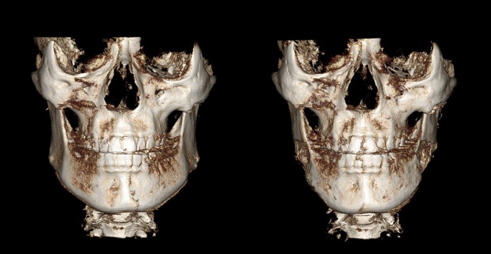 Square Jaw Surgery: What Are a Retracted Jaw and a Protruding Jaw? image 6