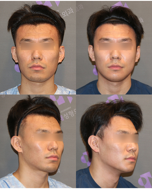 안면윤곽성형외과 실패하는 사람들의 공통점 관련 이미지 4
