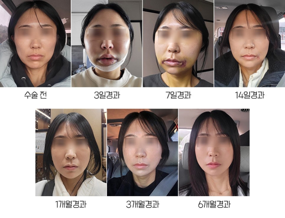 원장님, 윤곽수술하면 예뻐지는 게 맞나요? 관련 이미지 7