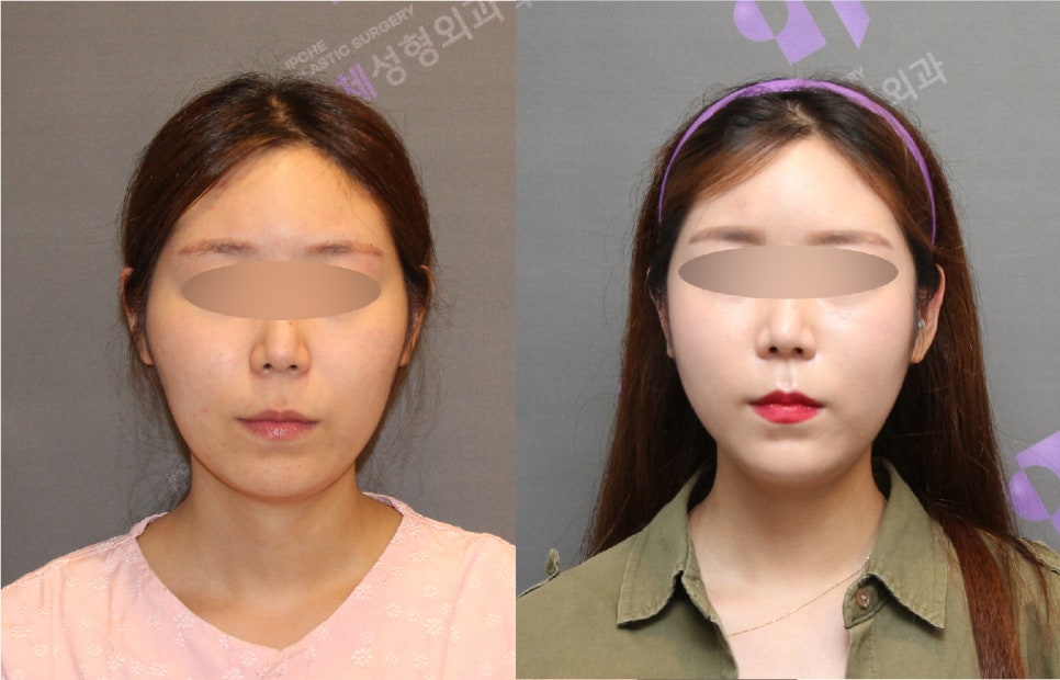 안면윤곽수술비용, 비쌀수록 좋은걸까요? -전문의가 알려드립니다. 관련 이미지 5