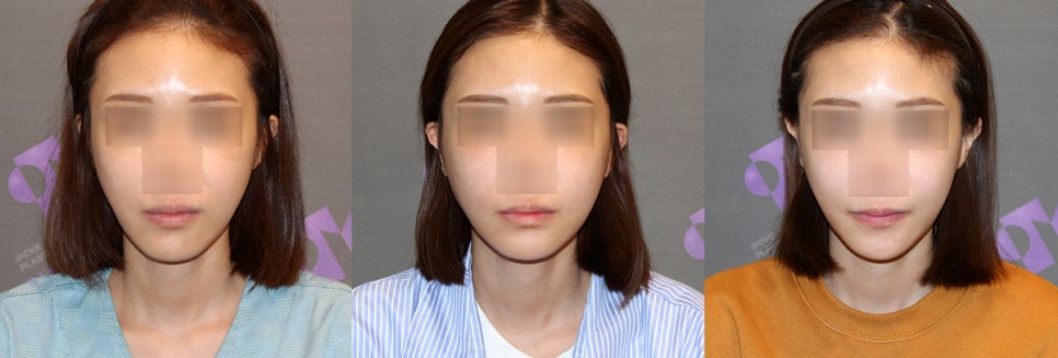 Is Pin Removal Surgery Necessary After Facial Contouring? What About Swelling and Recovery Time? image 5