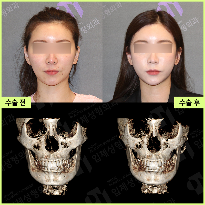Why Consultation and Design Are Important Before Facial Contouring Surgery—Don’t Be Careless!! image 6