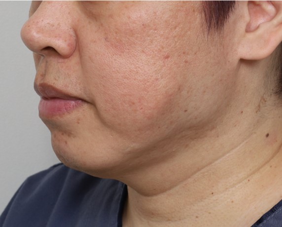 Amazing Changes Achieved with Contouring Facelift: A Facelift Technique That Even Addresses Asymmetry image 2