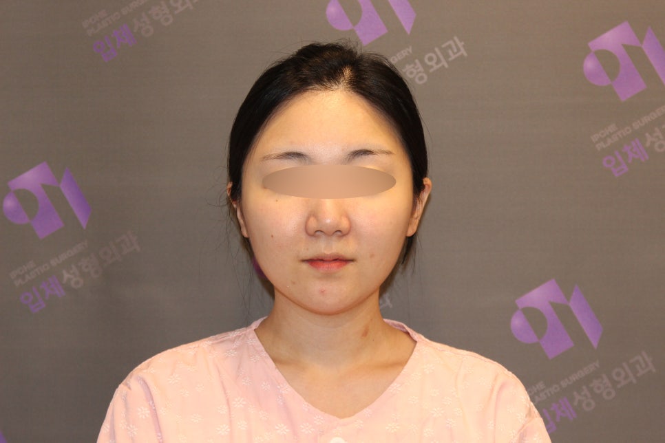안면윤곽수술비용, 비쌀수록 좋은걸까요? -전문의가 알려드립니다. 관련 이미지 7