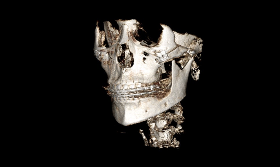 Why Are There So Many Methods for Cheekbone Surgery? A Look at Osteotomy Methods image 9