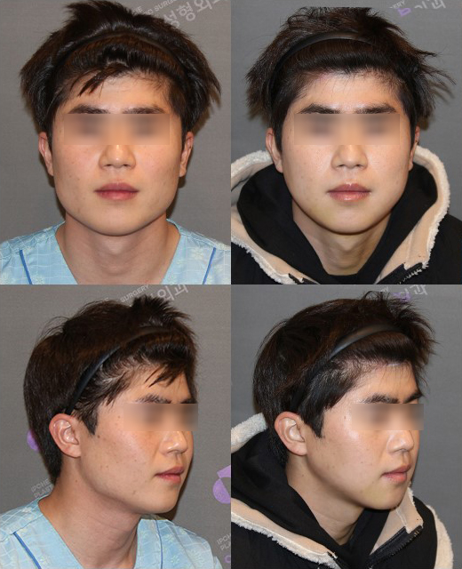 Jaw Contour Surgery: Why Is Revision Surgery Performed? image 7