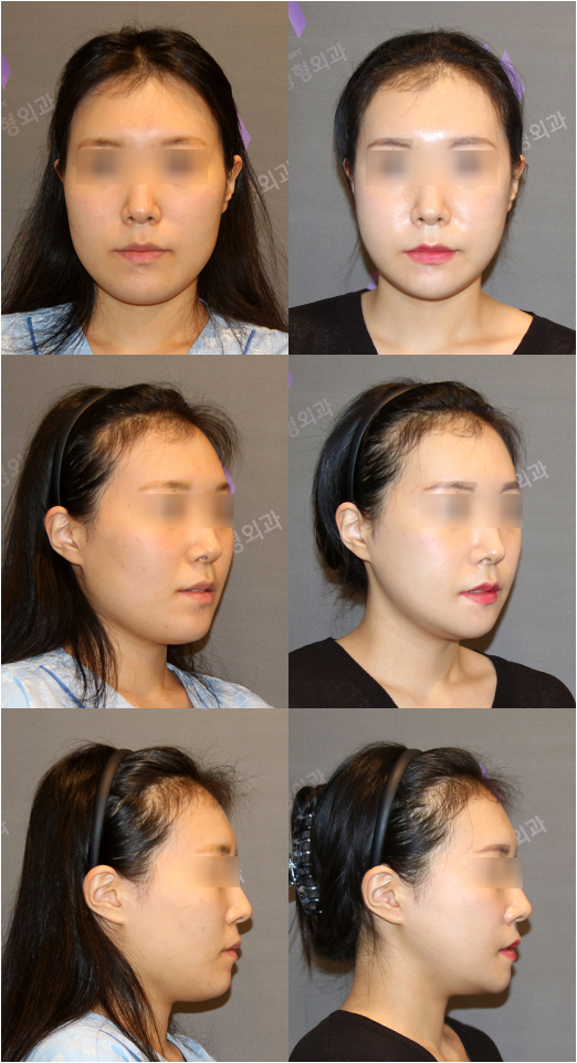 Let’s Take a Closer Look at Submental Muscles and Submental Muscle Tightening for a Double Chin image 1