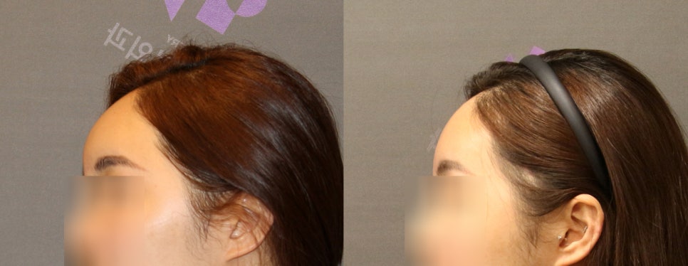 이마지방이식 제거 할 수 있을까요? 관련 이미지 7