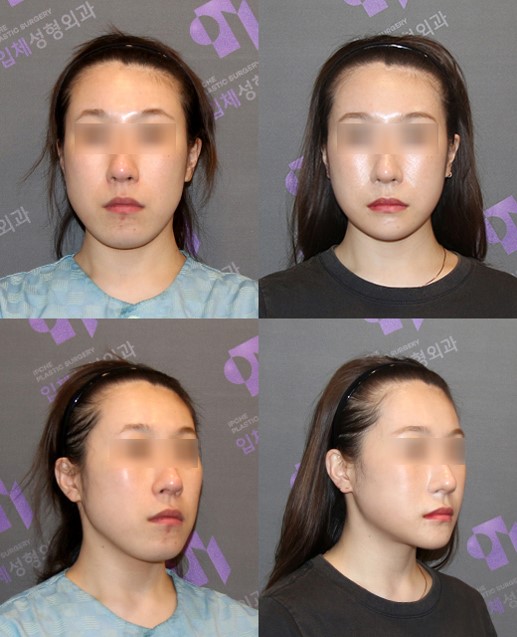 [논문 리뷰] 미용적 턱끝수술의 단계적 접근에 대해 : 앞턱비대칭, 무턱, 긴턱 교정 관련 이미지 11