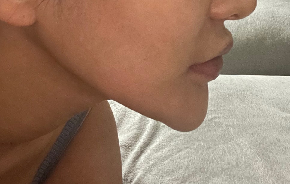 A Complication Called Chin Surgery Side Effects image 2