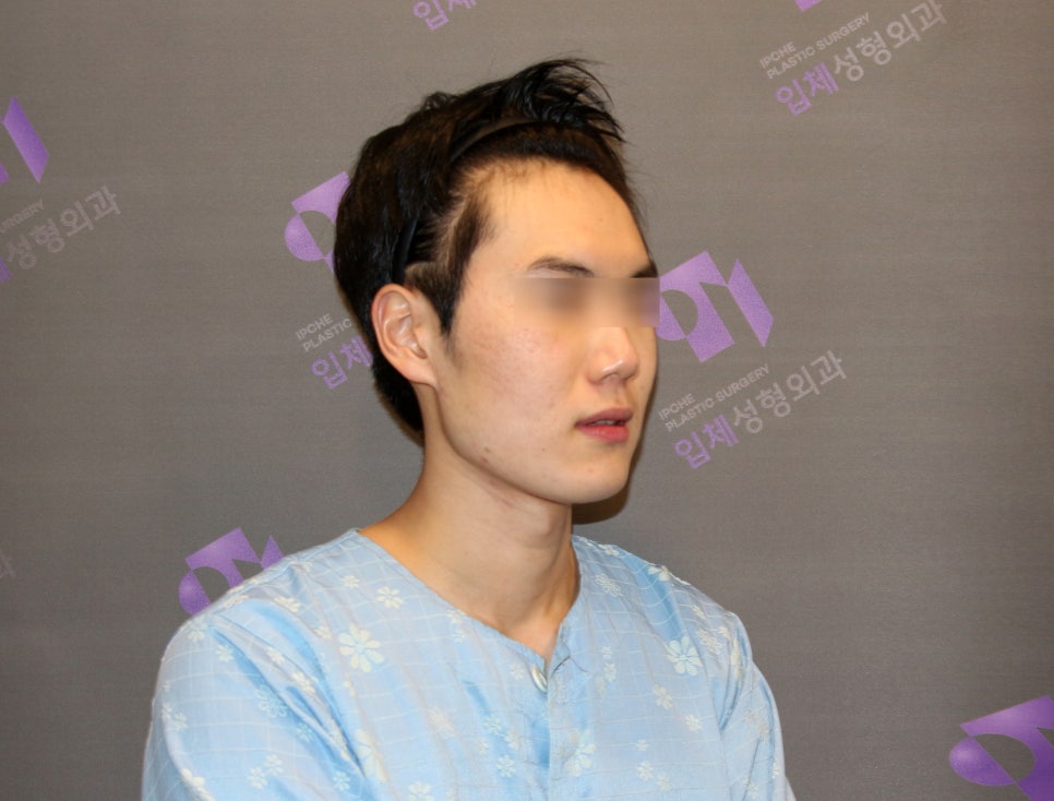 Male Facial Contouring (Zygoma Surgery, Square Jaw Surgery, Chin Surgery) - Explained by a Specialist. image 2