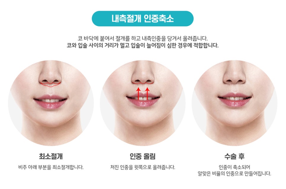 Surgery That Shortens the Midface Without Double Jaw Surgery: Philtrum Reduction Surgery image 1