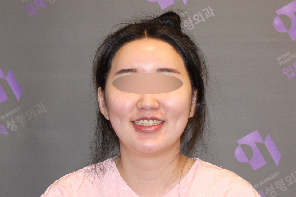 Why Cheekbones Show When You Smile, and Why Cheekbone Surgery May Not Help - Explained by a Specialist image 2
