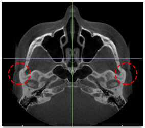 I had cheekbone surgery, but the back cheekbone remains. Is there a way to fix it? image 2