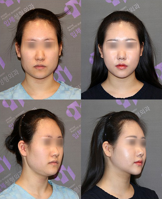Jaw Contour Surgery: Why Is Revision Surgery Performed? image 1