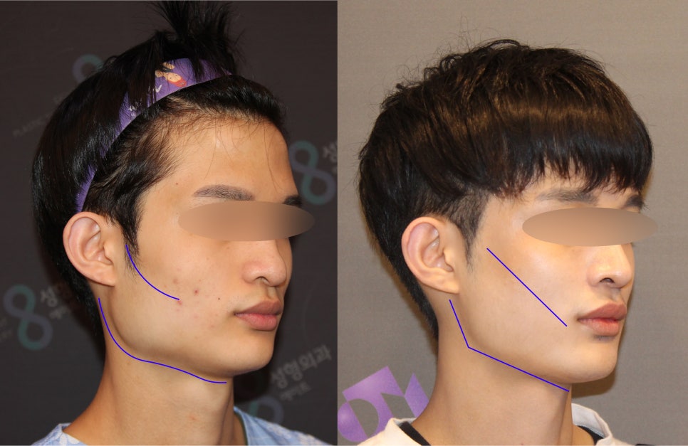 Male Facial Contouring (Square Jaw Surgery, Cheekbone Surgery, Chin Surgery) - Explained by a Specialist image 6