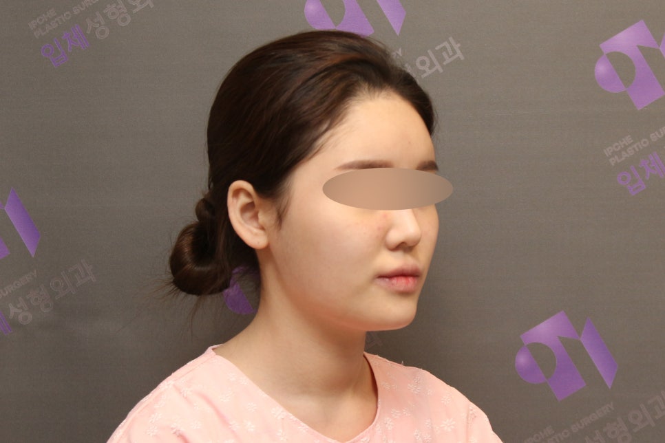안면윤곽, 연예인 신세경처럼 예뻐질수 있을까요? -전문의가 알려드립니다. 관련 이미지 2