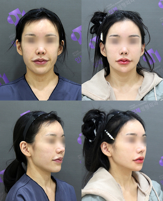 Long Midface and Lower Face Long-Face, Long-Chin Surgery - Cases That Do Not Require Double-Jaw Surgery image 15