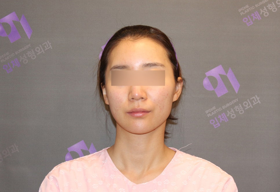 If the Face (Cheekbones) Is Asymmetrical, Can It Be Corrected with Cheekbone Reduction Surgery? image 4