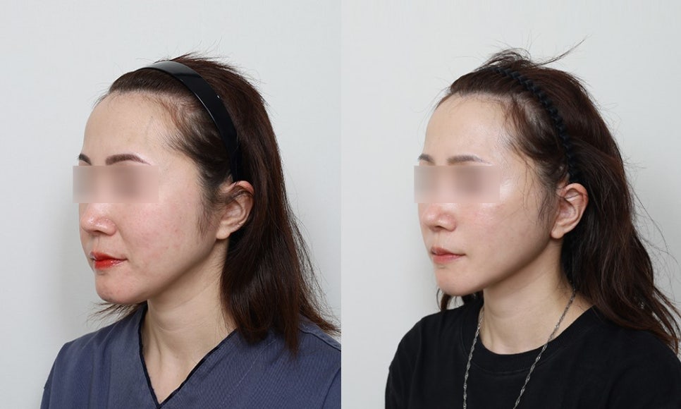 윤곽수술 후 생길 수 있는 관련 이미지 6
