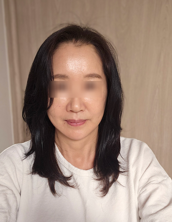 Facelift Recovery Period: When Will My Face Look Natural Again? image 5