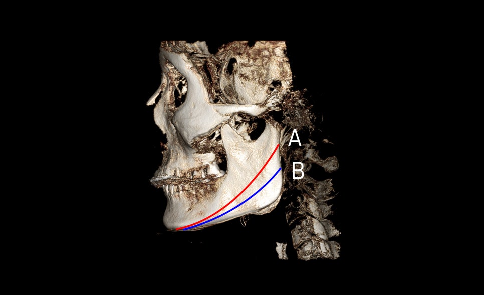 Side Effects of V-Line Square Jaw Surgery, Common Traits of People Who Experience Failed Results image 2