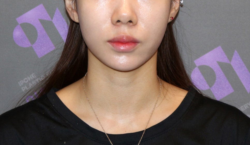 [Chin Surgery] Learning About Contouring Shaving and T-Osteotomy with Real Patient Cases (3) image 11