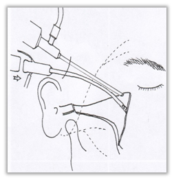 Why Are There So Many Methods for Cheekbone Surgery? A Look at Osteotomy Methods image 2