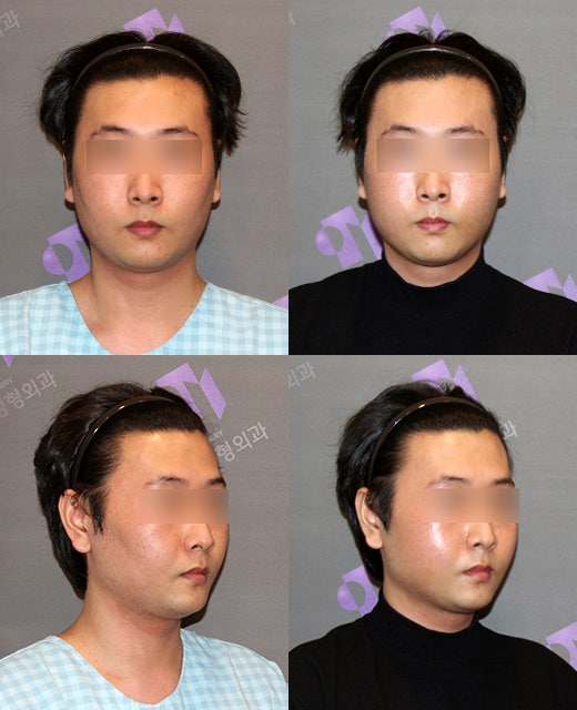 광대수술과 볼패임 교정을 같이 할 수 있나요? 관련 이미지 10