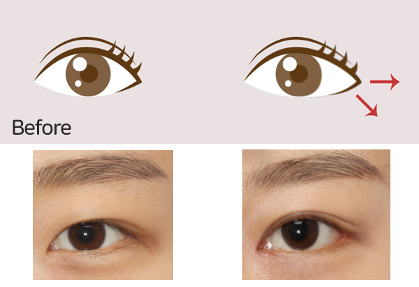 Surgery That Goes Well with Cheekbone Surgery, Part 1: Lateral and Lower Canthoplasty image 5