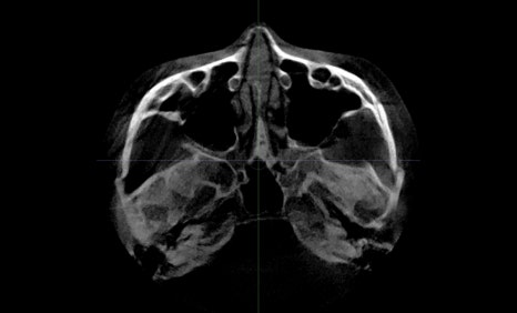 Consultation and Design Before Facial Contouring Surgery image 11