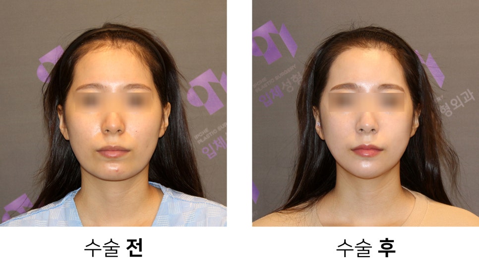 안면윤곽 연예인 고윤정, 카리나 얼굴형처럼 예뻐질 수 있을까요? 관련 이미지 4