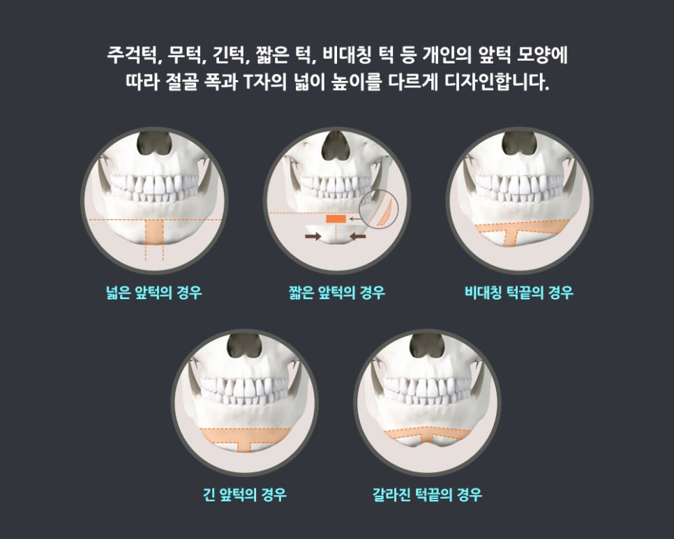 T절골 수술이라고 다 같은 수술이 아니예요! 관련 이미지 2