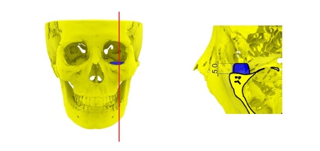 3D프린터 보형물을 이용한 안구함몰, 함몰눈 교정의 실제 사례 관련 이미지 6