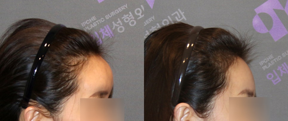 Forehead Fat Grafting Side Effects: Is There a Way to Remove Excess Fat? image 6