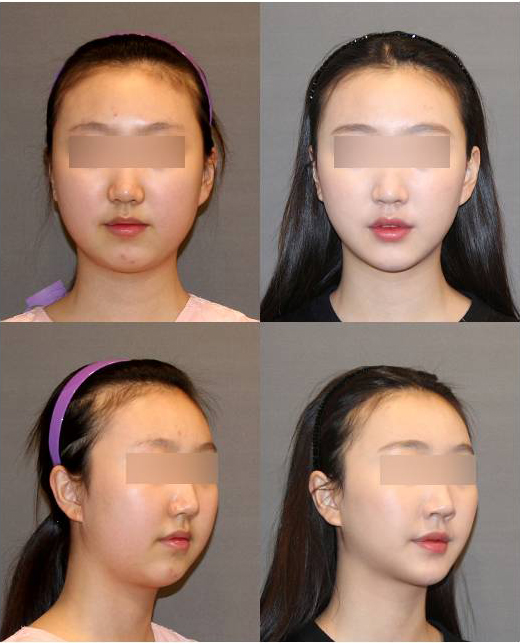 땅콩형 얼굴은 어떻게 개선할 수 있을까요? 관련 이미지 7