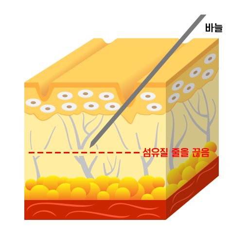 Is it true that cheekbone surgery causes an Indian wrinkle? image 6
