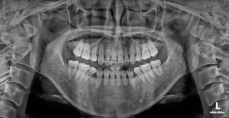 Long Midface and Lower Face Long-Face, Long-Chin Surgery - Cases That Do Not Require Double-Jaw Surgery image 13