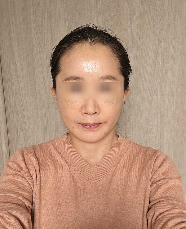 Facelift Recovery Period: When Will My Face Look Natural Again? image 3