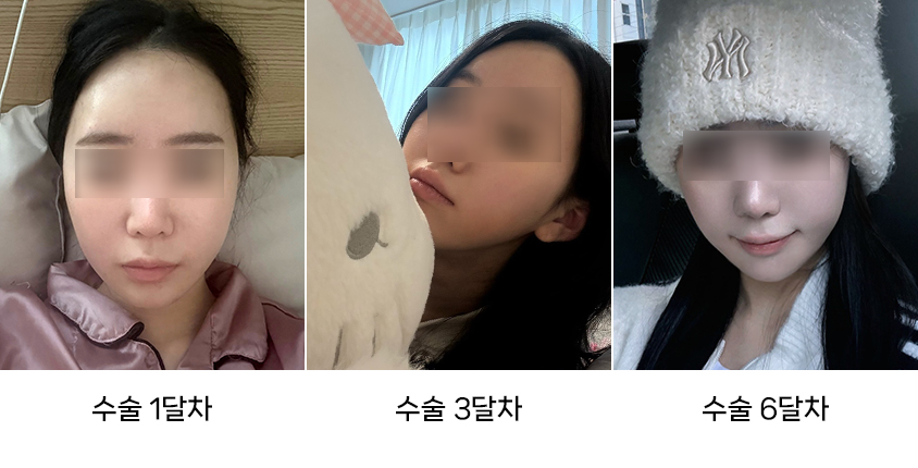 The Difference Between Swelling and Cheek Sagging After Facial Contouring Surgery image 6