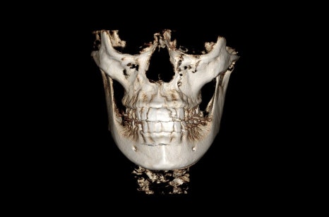 Square Jaw Surgery: What Are a Retracted Jaw and a Protruding Jaw? image 4