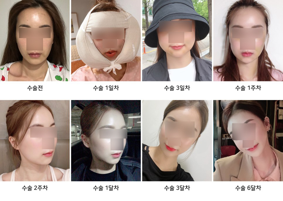 안면윤곽 수술 후 붓기와 회복기간, 케이스 바이 케이스 관련 이미지 1